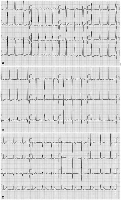 ECG with delta wave. ECG showed the change of delta wave before ...