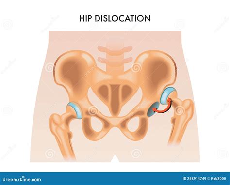 Hip Dislocation Illustration Stock Vector Illustration Of Care