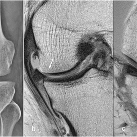 A Frontal Radiograph Of Knee Depicting Mild Medial Femorotibial Joint