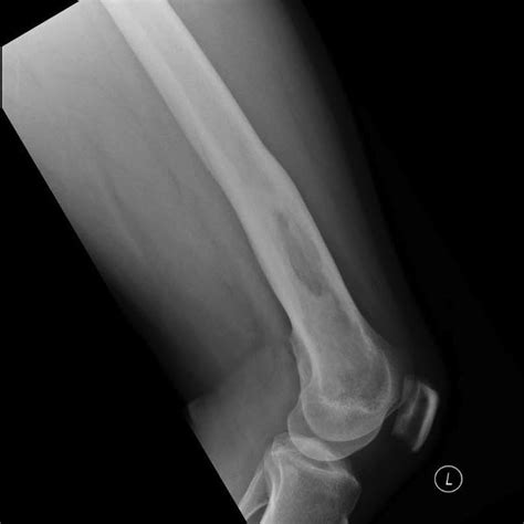 Melioidosis Manifesting As Chronic Femoral Osteomyelitis Of The Left