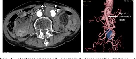 Figure 1 From Peripheral Inflammatory Superior Mesenteric Artery