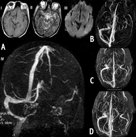 Superior Sagittal Sinus Thrombosis