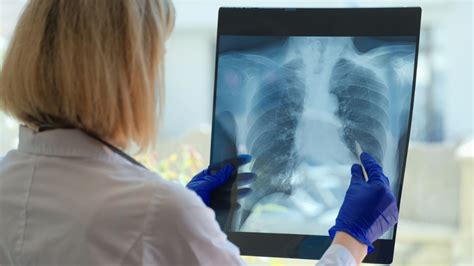 What Is ‘white Lung Syndrome Mysterious Pneumonia Outbreak Raising Alarms In Many Countries