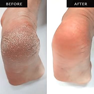 Best Foot Callus Removal Singapore | NING Spa Jewel Changi