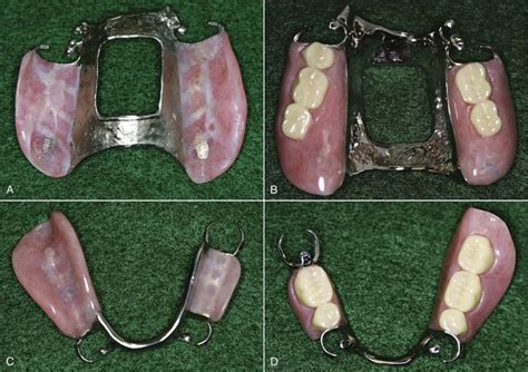 9 Denture Base Considerations Pocket Dentistry