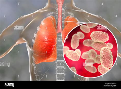 Whooping Cough Conceptual Illustration Whooping Cough Is A Highly