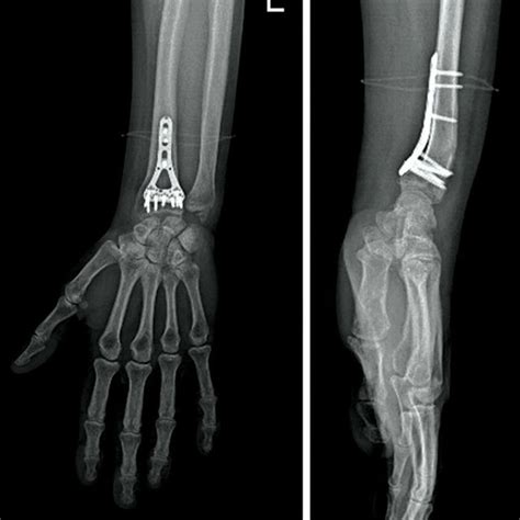 Two Way X Ray Images On Postoperative Day 1 Of A 53 Year Old Female Download Scientific Diagram