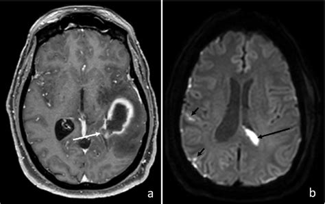 Axial Mri Of The Brain Indicative Of Cerebral Abscess A T2 Weighted Download Scientific