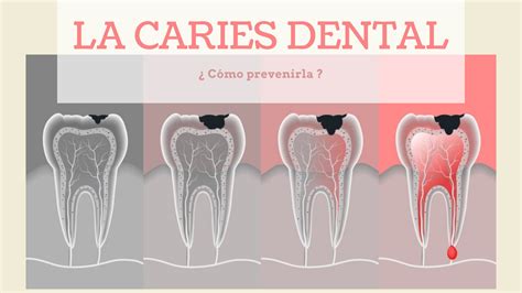 C Mo Prevenir Las Caries En Los Ni Os Infografia Escuela De Higiene