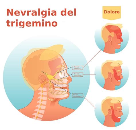 Nevralgia Del Trigemino Sintomi Cause E Terapia Valori Normali