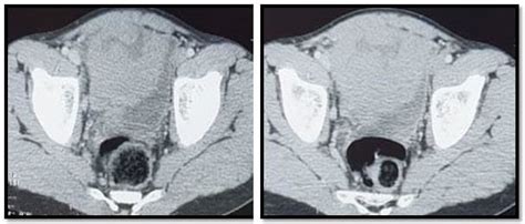 Computed Tomography Of The Lower Abdomen And Pelvis Demonstrates The