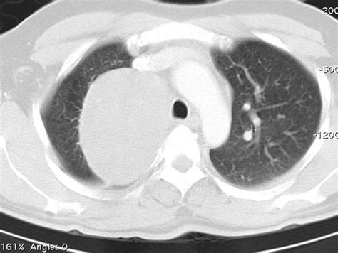 Bronchogenic Cyst Image Radiopaedia Org