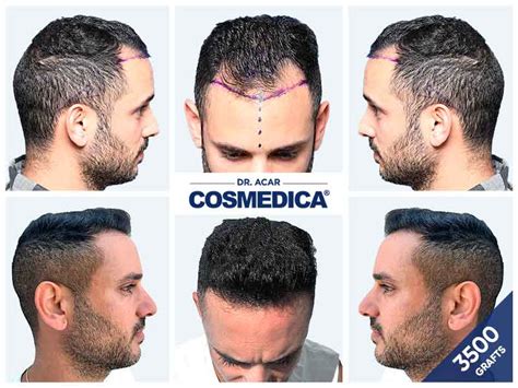 Hair Transplant Turkey Before After Cosmedica Dr Acar