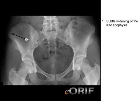 Iliac Apophysitis M9390 7329 Eorif