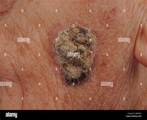 Carcinoma Epidermoide Fotografías E Imágenes De Alta Resolución Alamy