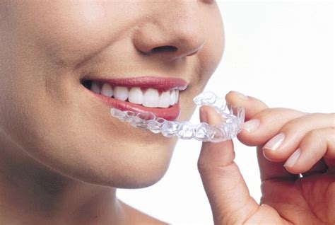 Parchment Street Dental Winchester Dental Practice Invisalign