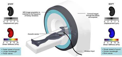 Magnetic Resonance Elastography To Assess Fibrosis In Kidney