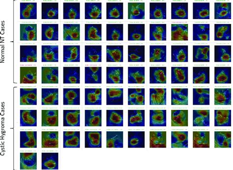 Grad CAM Heat Maps For The Full Validation Set Of Fold 2 Top 4 Rows