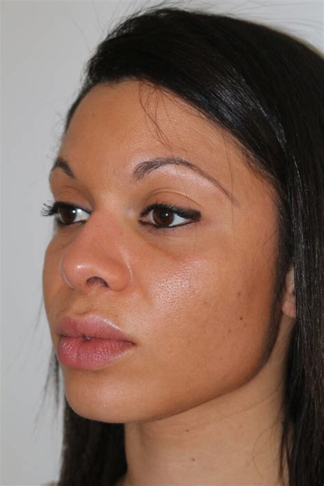 Photos avant après de rhinoplastie ethnique par le Dr Ouakil à Paris