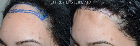 Forehead Reduction Surgery Photos Miami FL Patient53831