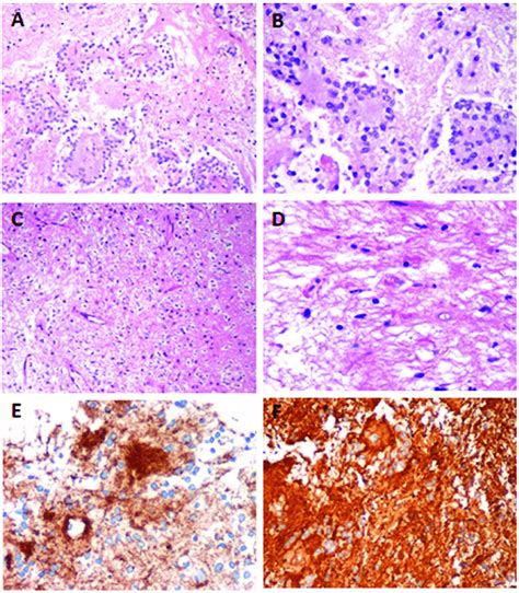 Histologic Features Of The Rosette Forming Glioneuronal Tumor Of The Iv