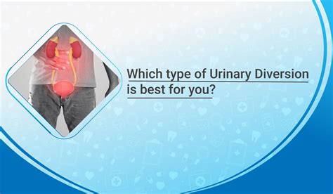 Which Type Of Urinary Diversion Is Best For You