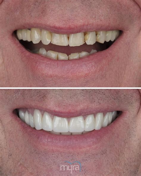 Zirconium Veneers Treatment In Turkey R Myradentalcentre