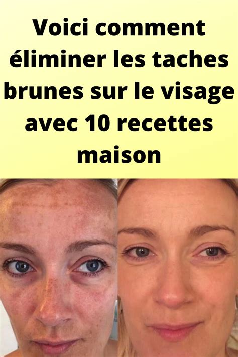 Voici comment éliminer les taches brunes sur le visage avec 10 recettes