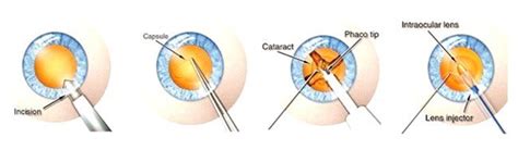 Modern Technique Of Cataract Surgery Axis Eye Clinic