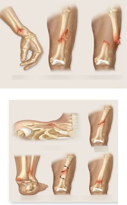 Types Of Bone Fractures Diagram Quizlet