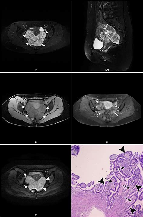 Role Of Mri In Characterizing Serous Borderline Ovarian Tumor And Its