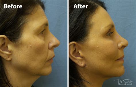 Face And Neck Lift 4 Dr Schalit Cosmetic Facial Specialist