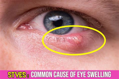 Do Styes Cause Eyelid Swelling Symptoms And Treatment