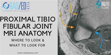 MRI KNEE ANATOMY: PROXIMAL TIBIOFIBULAR JOINT - Radedasia