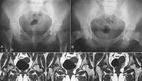 Anteroposterior A And Frog Leg Lateral B Radiographs Of The Pelvis