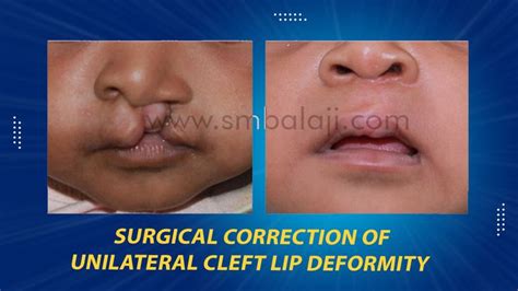 Surgical Correction Of Unilateral Cleft Lip Deformity Cleft Lip