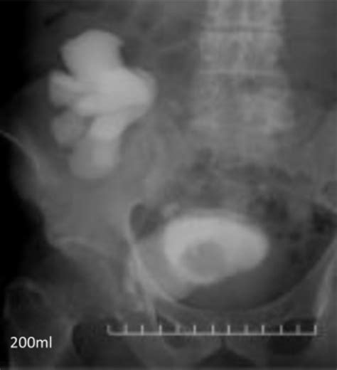 Voiding Cystourethrography Before Holep Contrast Medium Was Injected