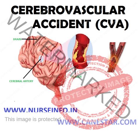 Cerebrovascular Accident Stroke Nurse Info