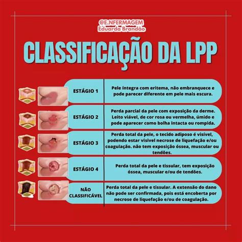Lpp Na Enfermagem - LPP: CLASSIFICAÇÃO | Oração da cruz sagrada, Tudo sobre enfermagem ...