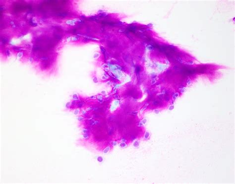 Pathology Outlines Pleomorphic Adenoma