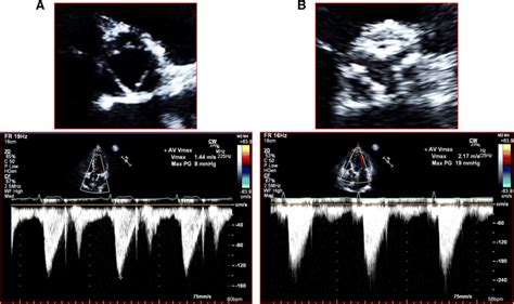 The transthoracic echocardiographic images of normal aortic valve and... | Download Scientific ...