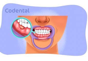 Caroço na gengiva saiba o que pode ser Codental Blog