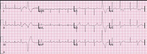 Dr Smiths Ecg Blog Dynamic T Wave Inversion Apparent Wellens Waves