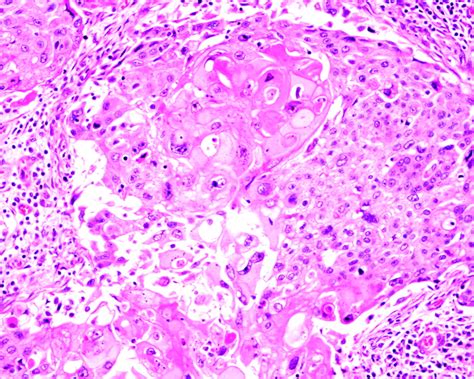 Metaplastic Carcinoma Of The Breast A Clinicopathological Review Journal Of Clinical Pathology