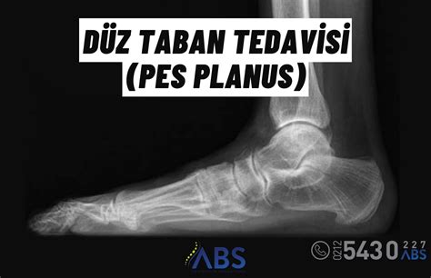 Düz Taban Tedavisi Pes Planus Ahmet Burak Sezgin