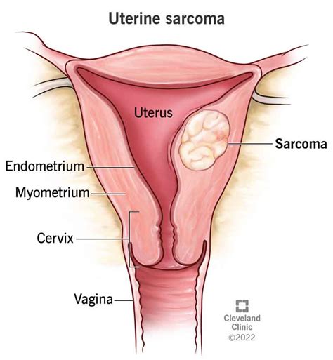 Leiomyosarcoma Cancer: Causes, Symptoms, Treatment, What It, 41% OFF