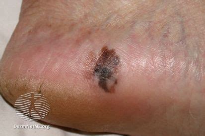 Melanoma Symptoms Causes Treatment Mid Tn Skin Surgery Center