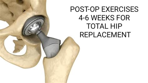 Post Operative Exercises Weeks 4 6 For Total Hip Replacement Youtube