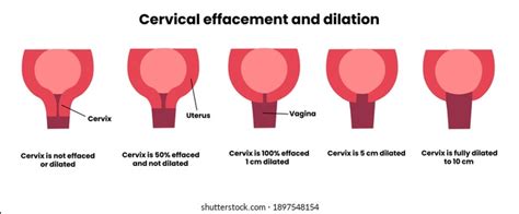 Dilation And Effacement Of Cervix Trial Exhibits