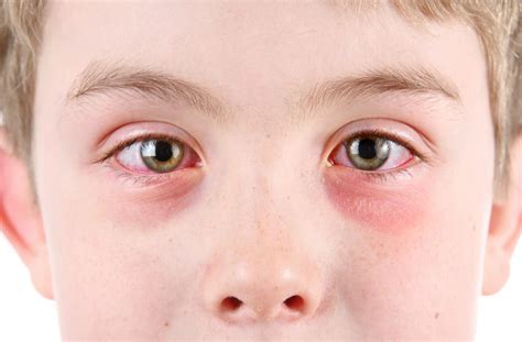 Stye Vs Conjunctivitis How To Tell The Difference